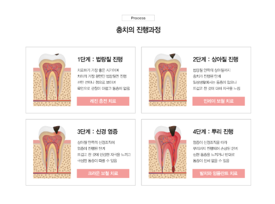 안산충치치료 - 충치 진행과정
