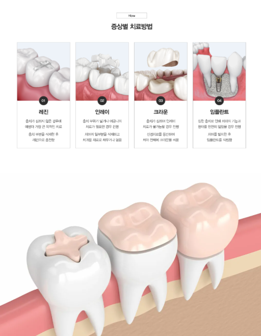 안산충치치료 - 충치 증상별 치료방법